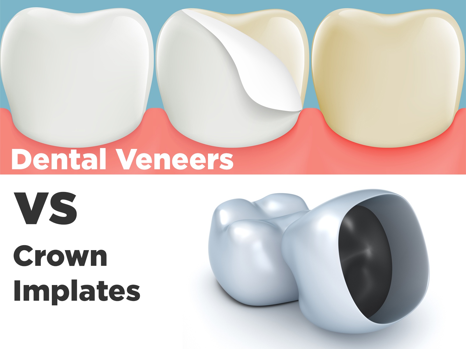 Dental Veneers vs Crown Implates. What Should You Choose?
