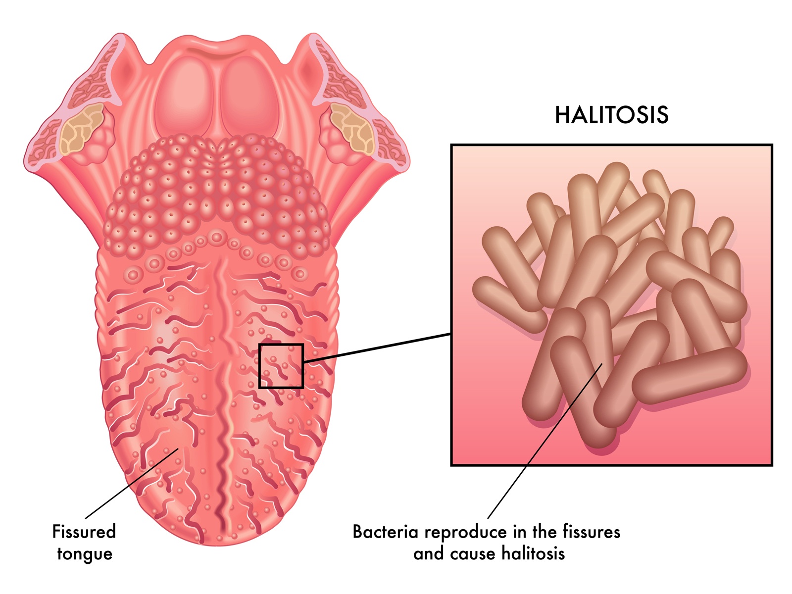 What is a Fissured Tongue?