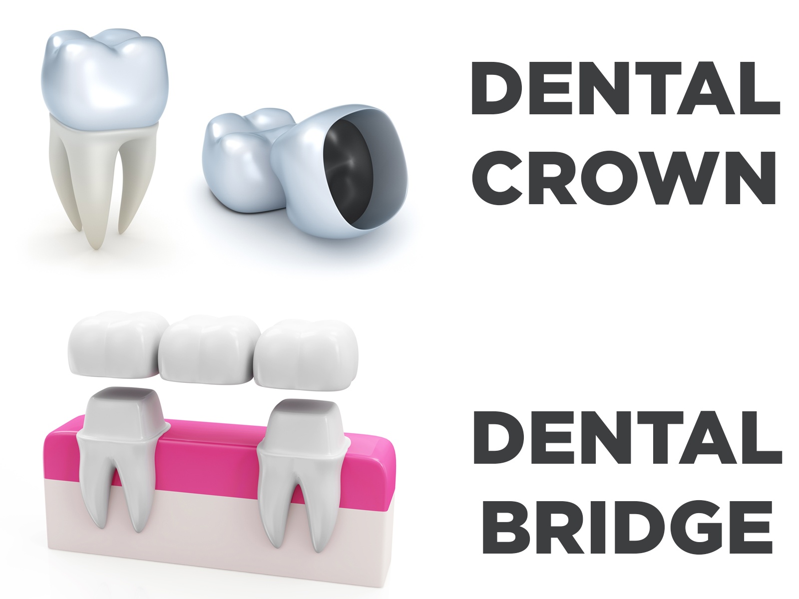 What You Need to Know About Crowns and Bridges