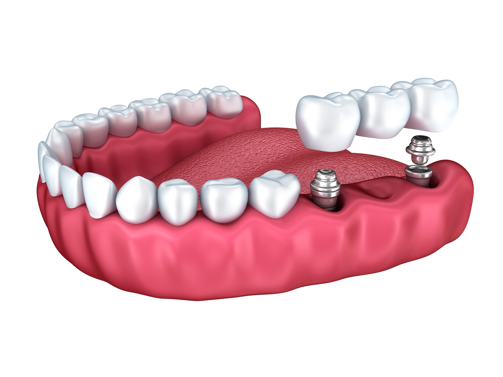 Do dental implants fall out?
