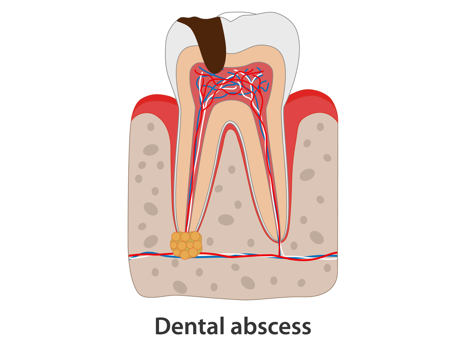 How Long Can a Tooth Abscess Go Untreated?
