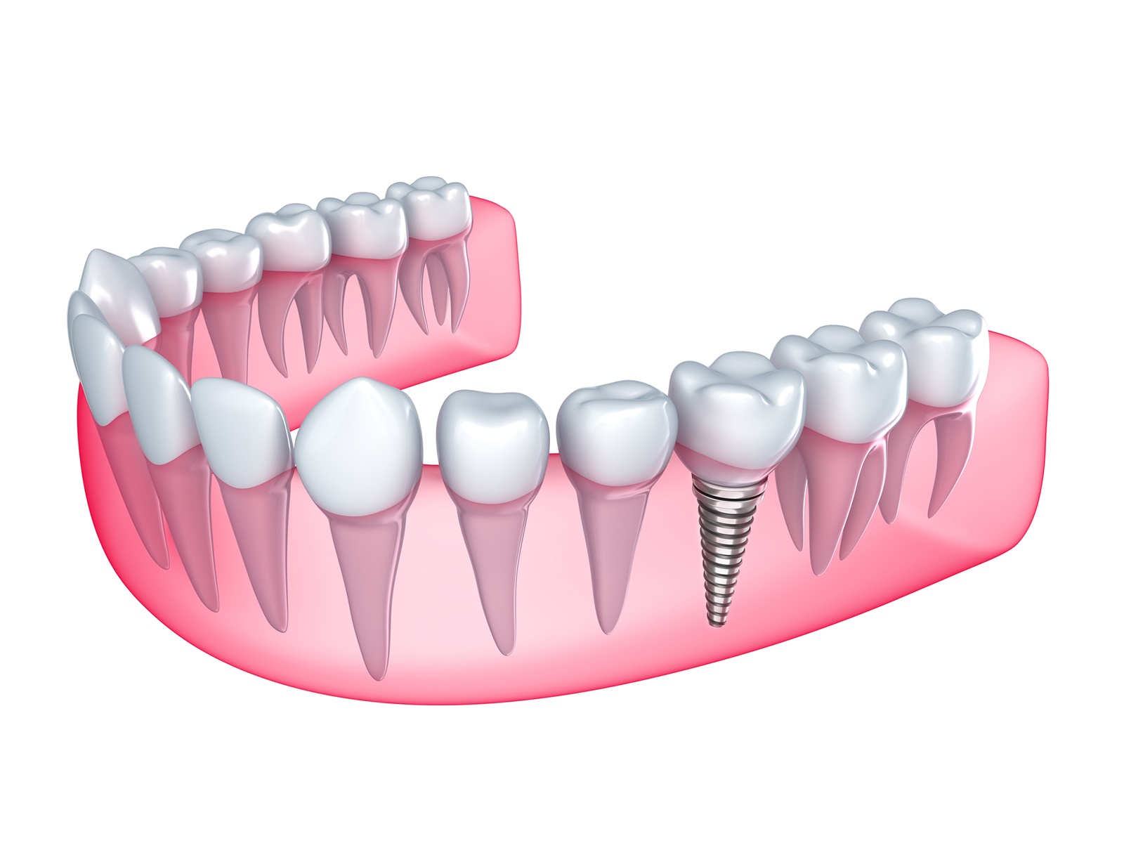 How long after dental implants can I eat normally?