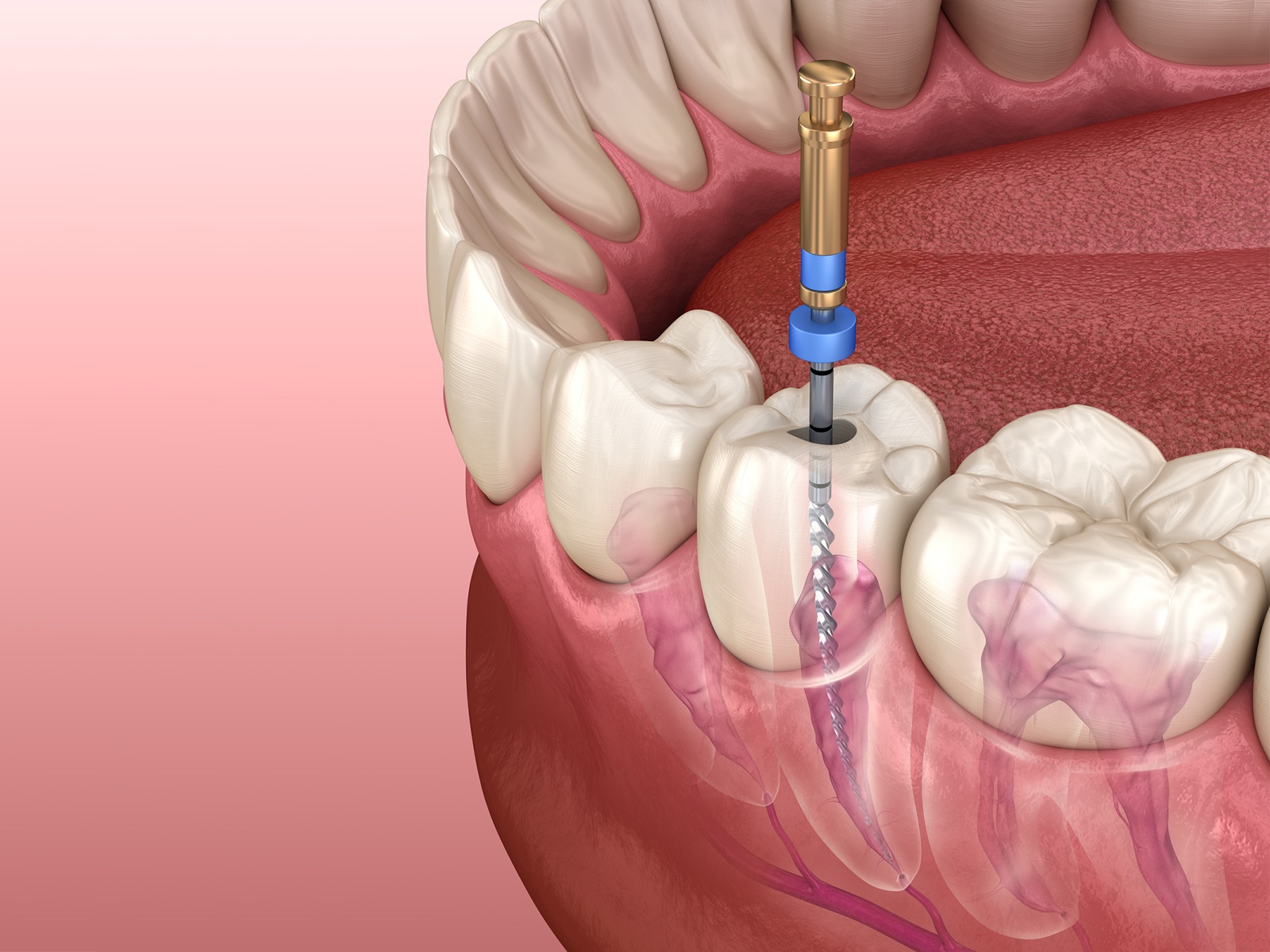 Can Nerves Grow Back After Root Canal?