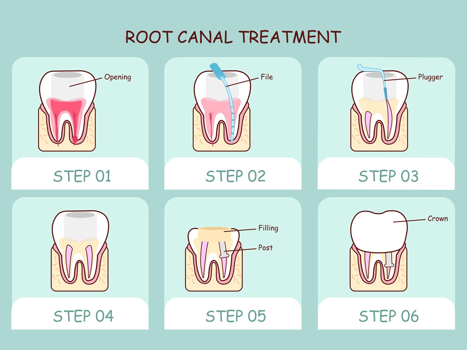 How many appointments does a root canal take?