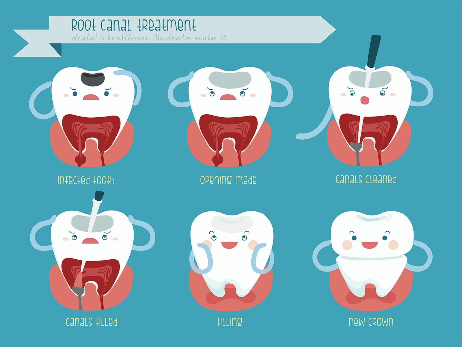 tooth that needs root canal