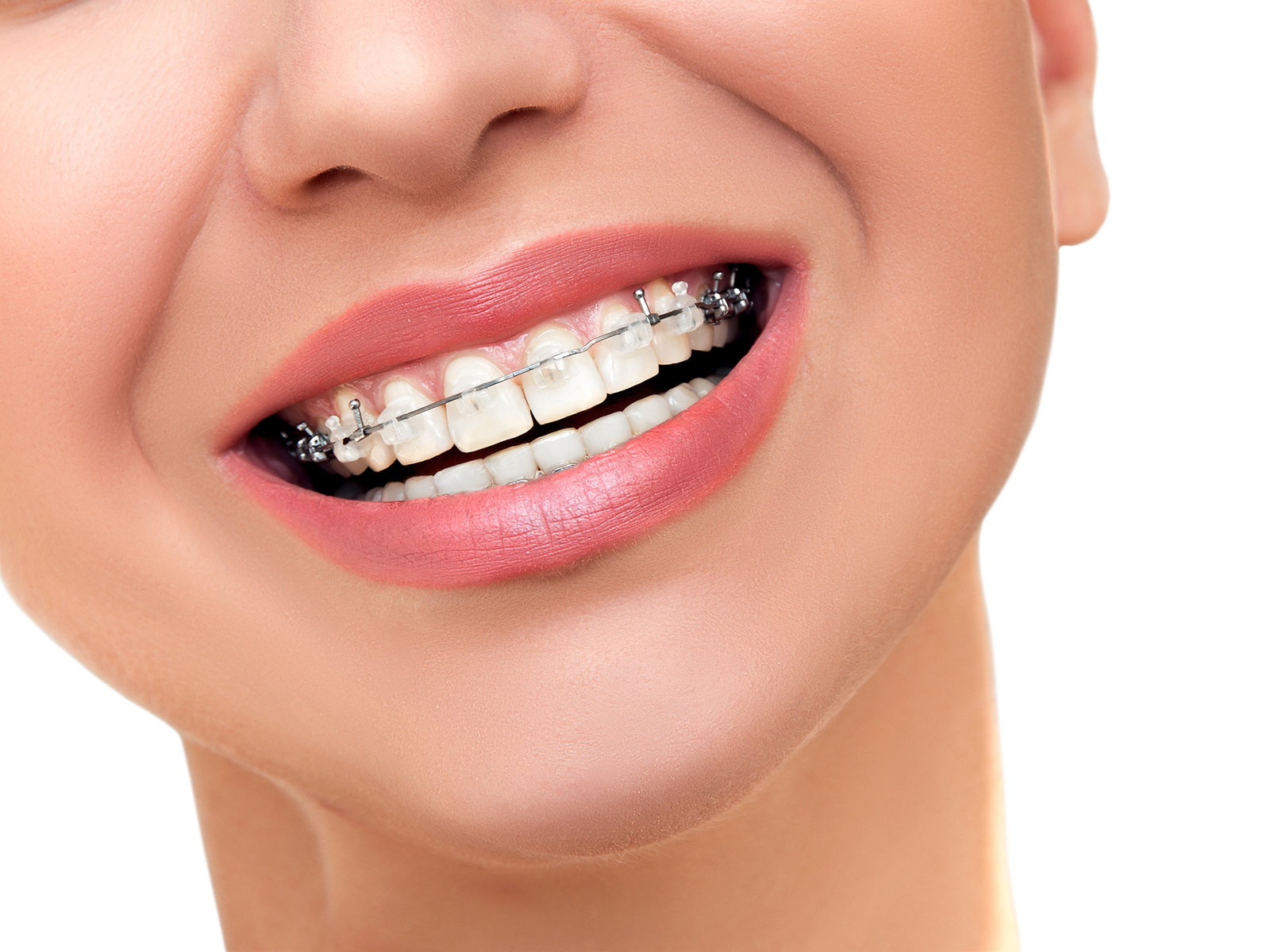 Are colored braces more expensive?