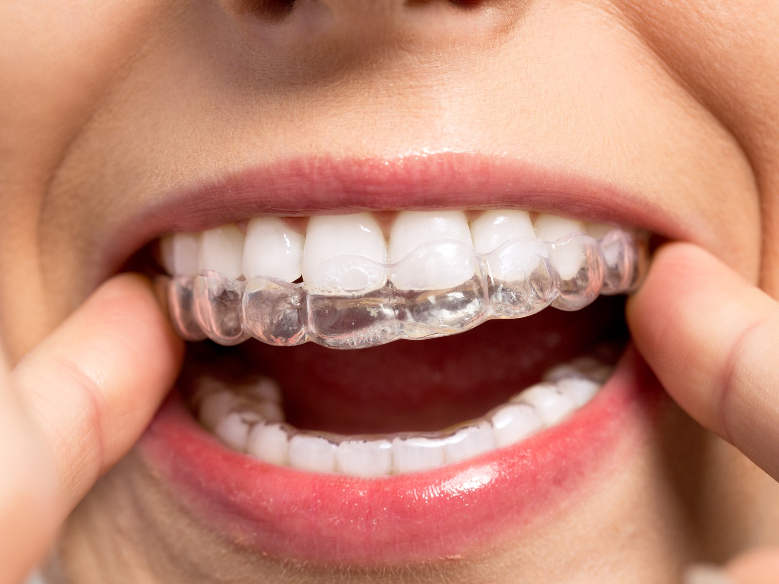 Can Invisalign intrude teeth?