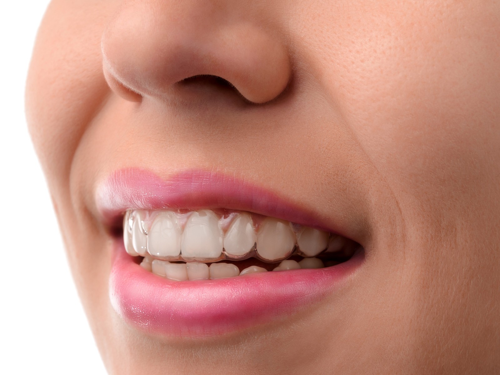 Does Invisalign whiten teeth?