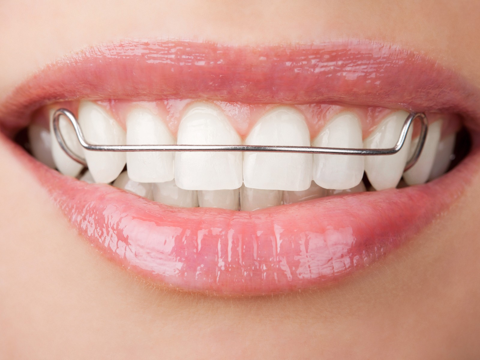 Can retainers damage teeth?