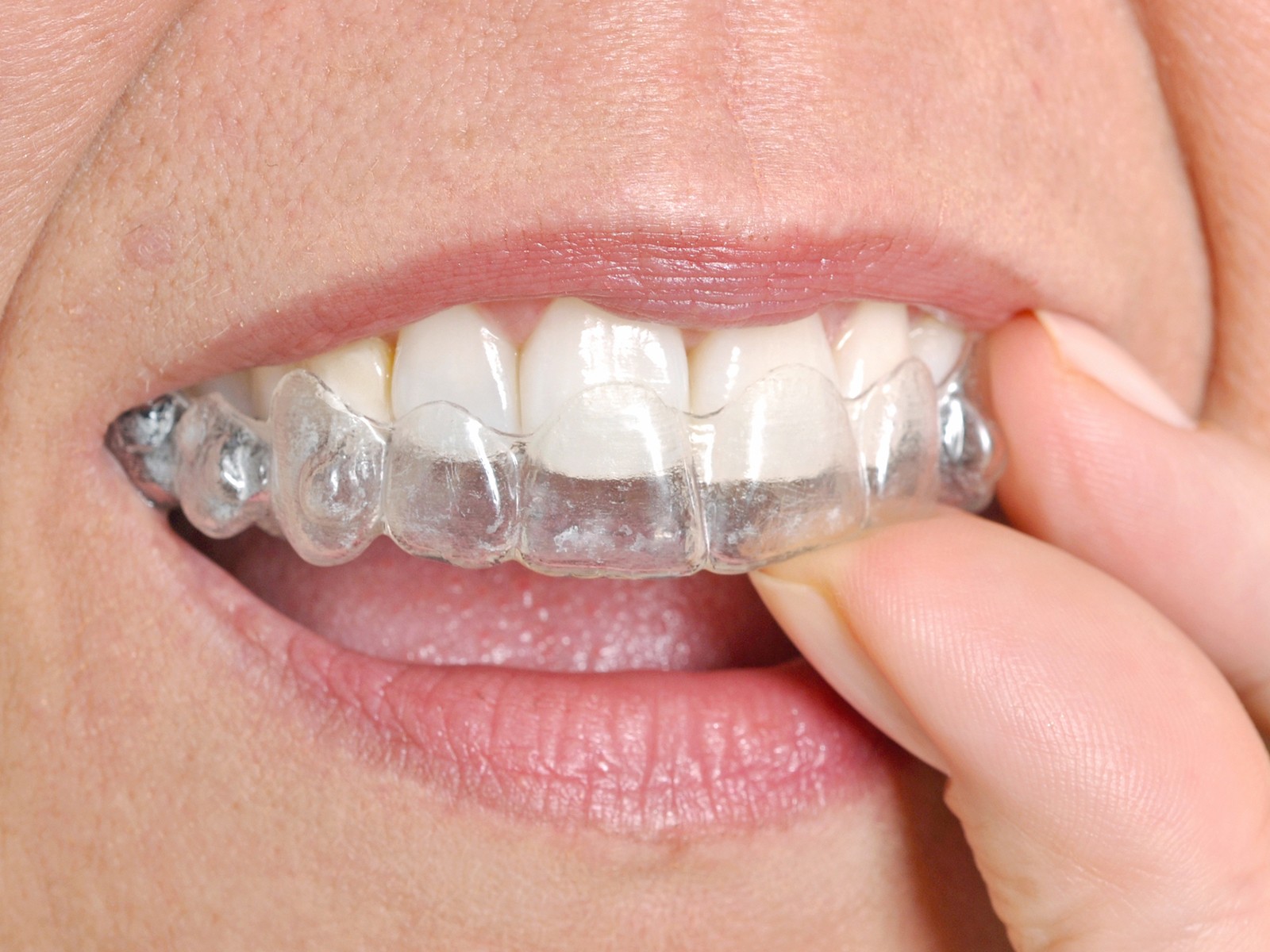 What toothpaste is best for Invisalign?
