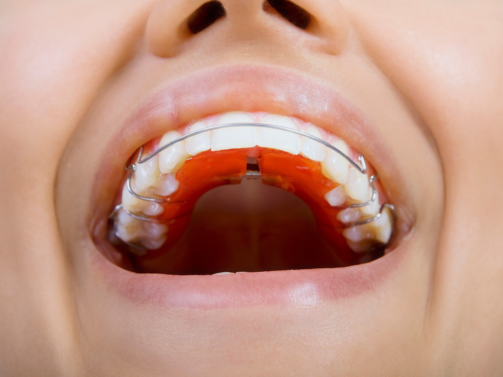 How long does it take a retainer to move teeth back?