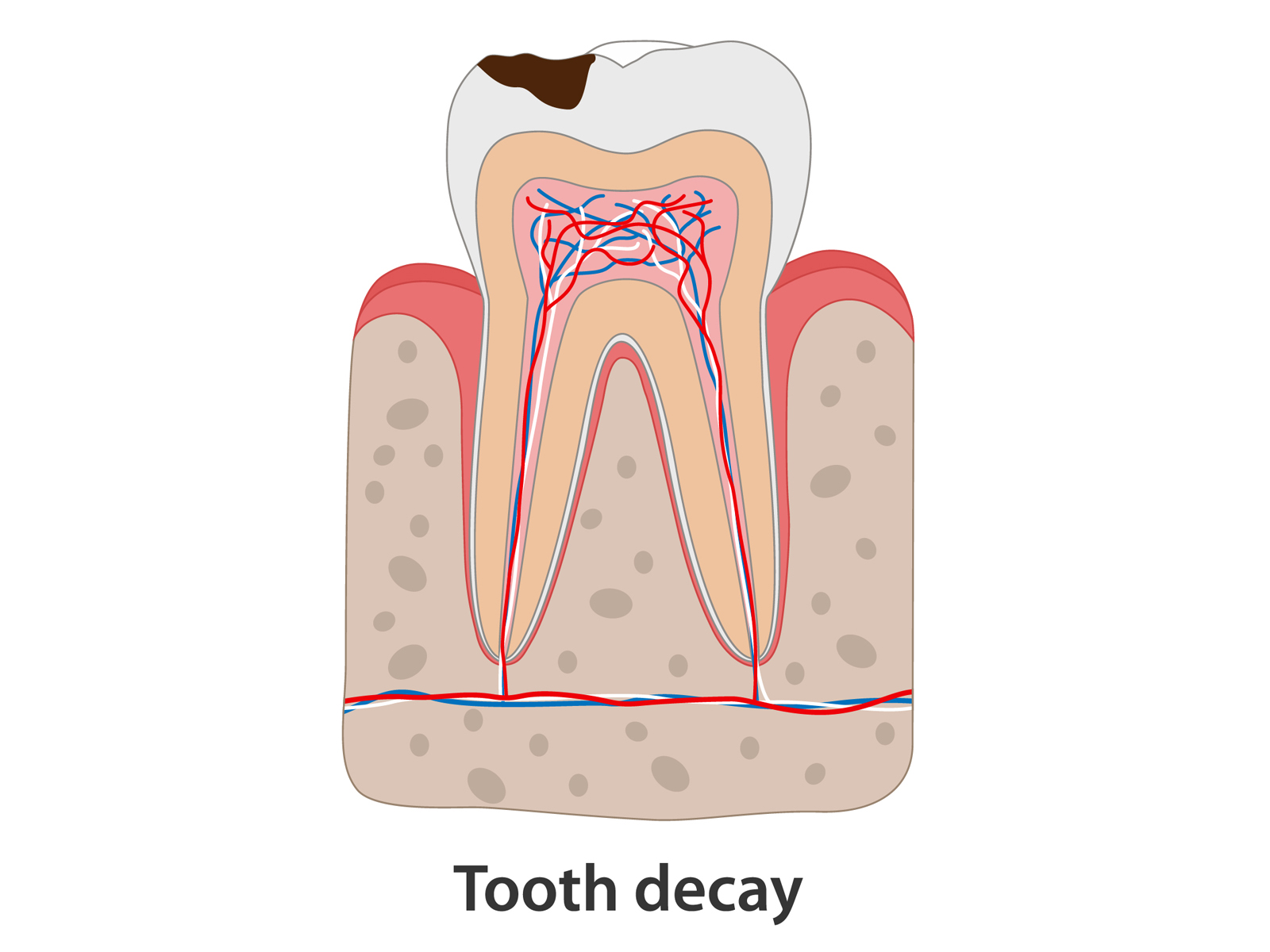 Common Diseases That Cause Tooth Decay