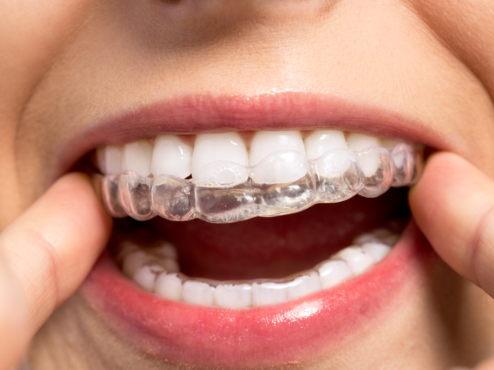 How painful is Invisalign?