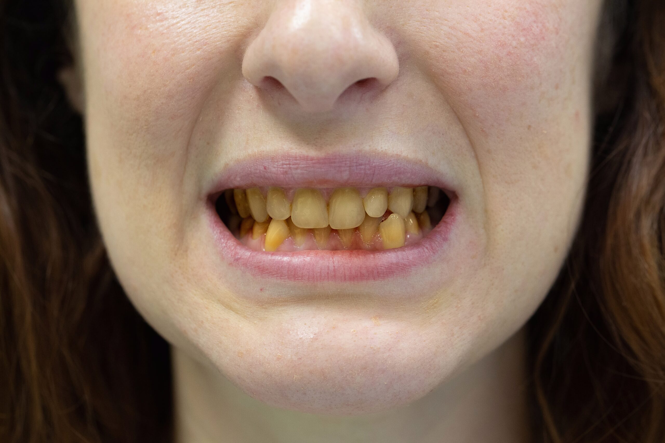 What are the most common causes of teeth discoloration?