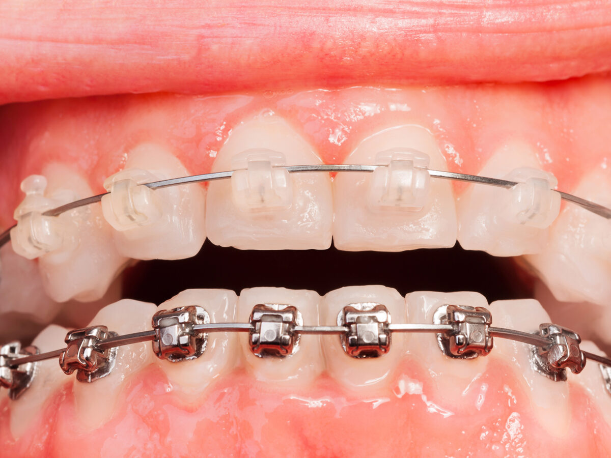 Dentist Fixes Braces with an Photopolymer Lamp in Dental Clinic