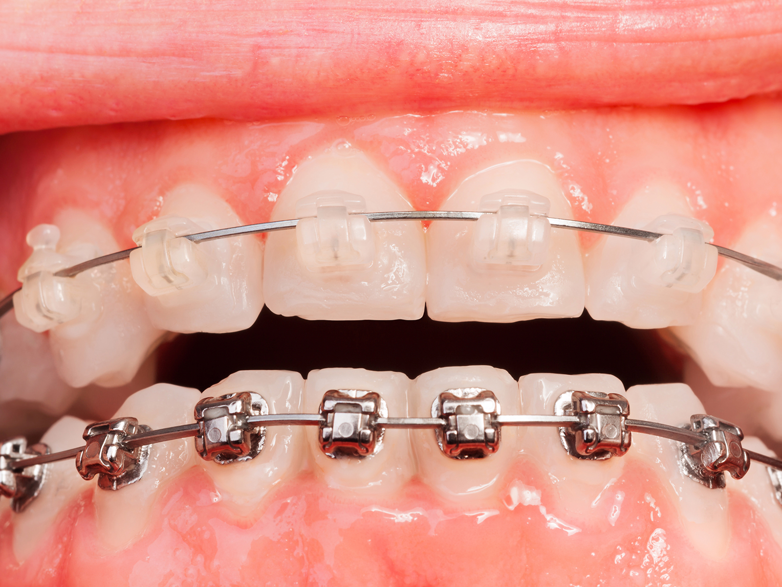 Ceramic Braces