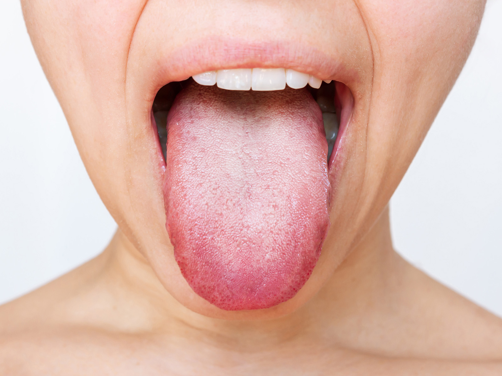White Tongue: Symptoms, Causes And Treatment