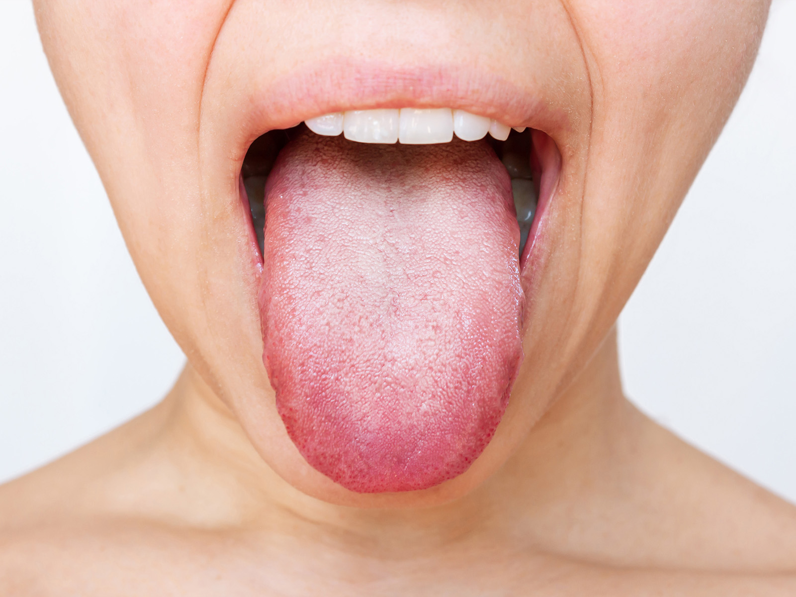 White Tongue Symptoms Causes And Treatment