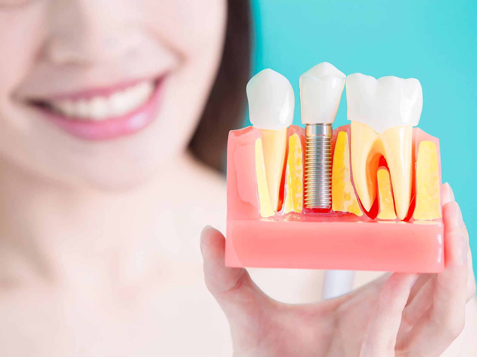 How Do I Keep My Dental Implants Clean?