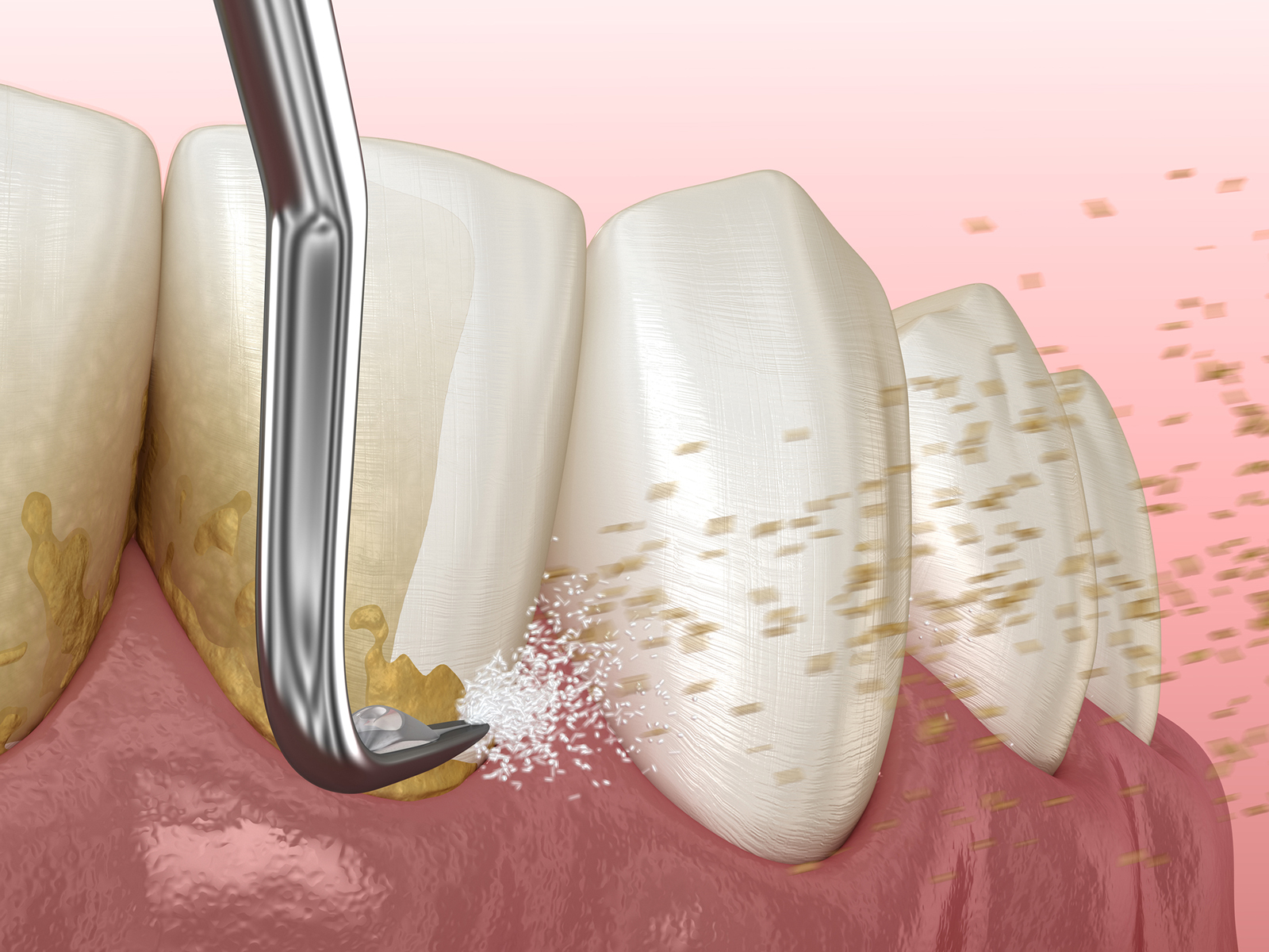Can Scaling And Root Planing Help In Treating Receding Gums?