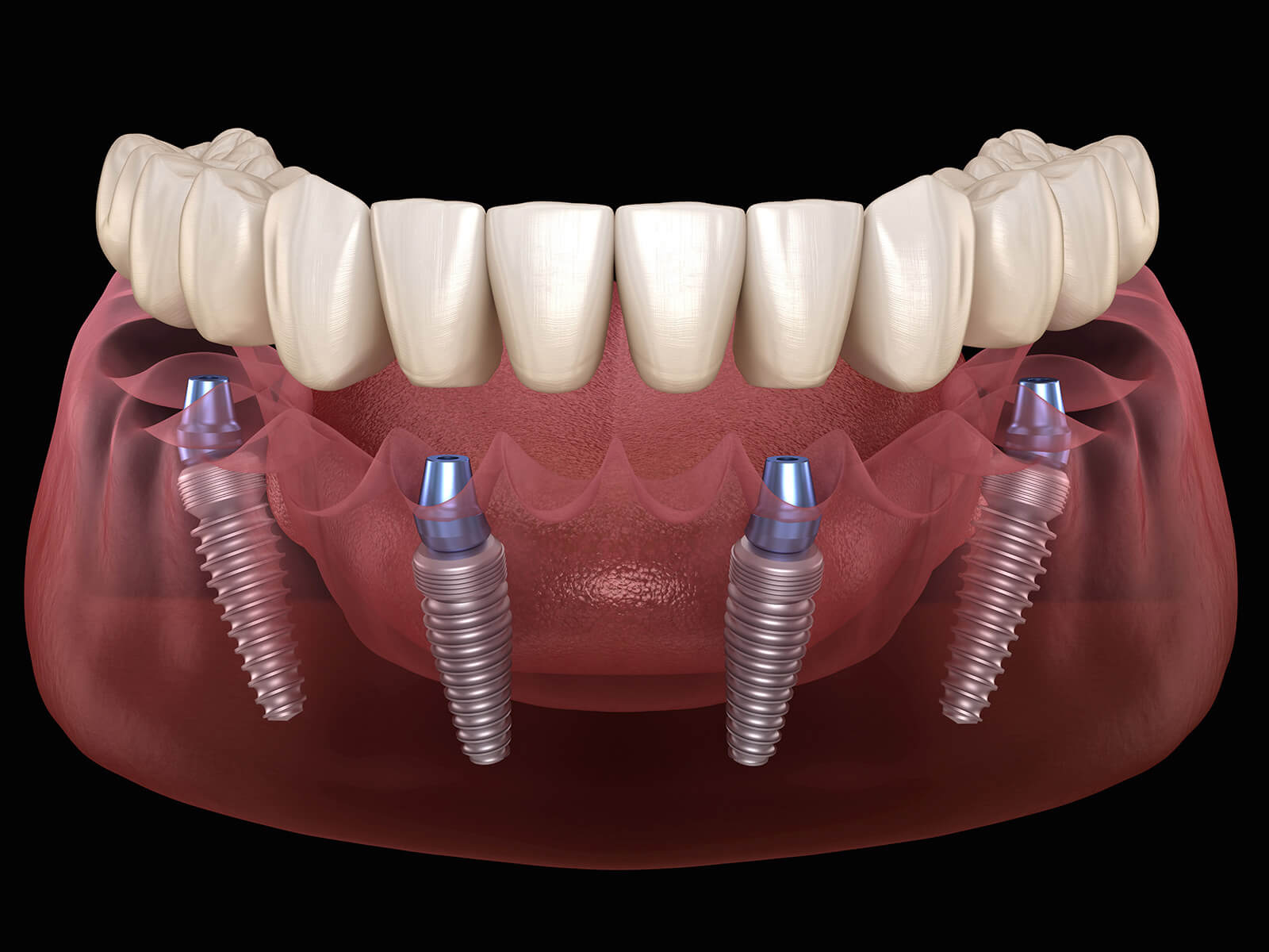 What Can You Eat After Getting Allon4 Dental Implants?