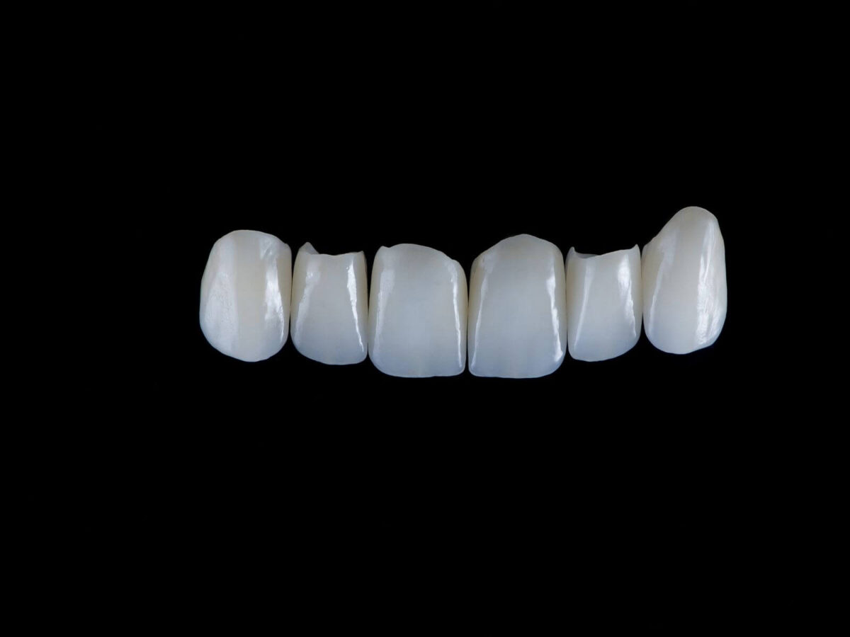 Benefits of Dental Crowns