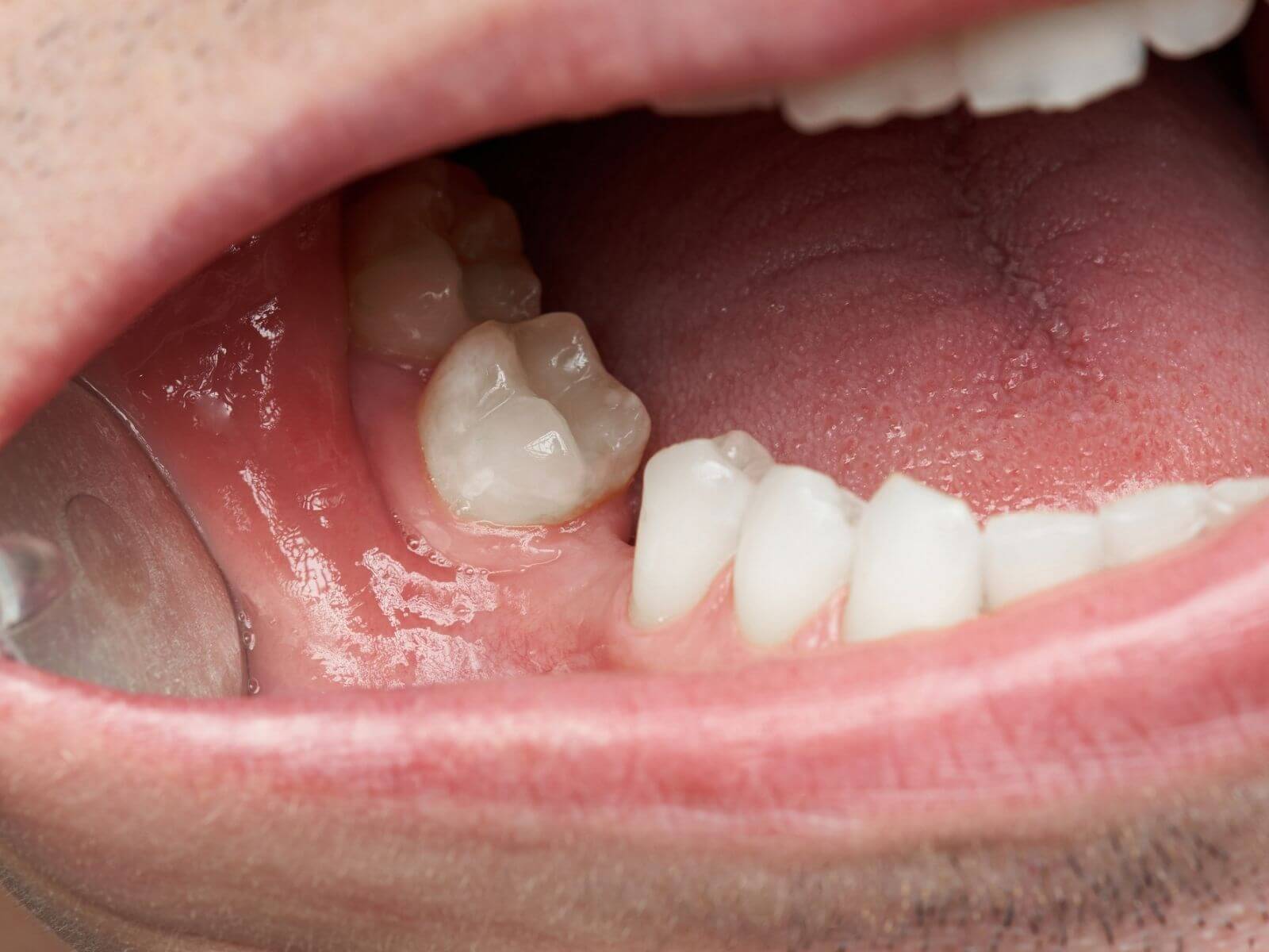 Why Replacing Missing Teeth Is Essential