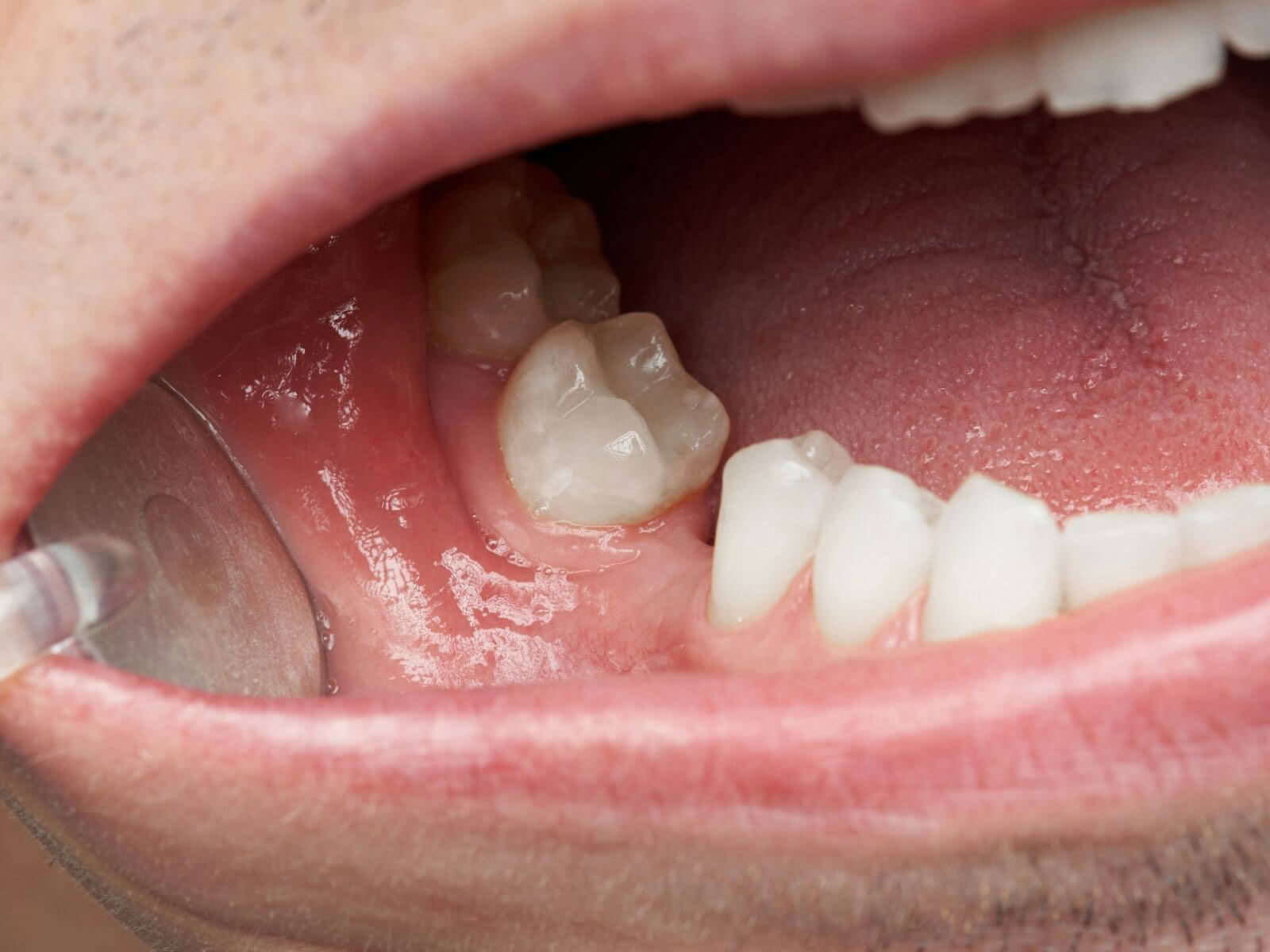 5 Signs You Might Need a Tooth Pulled