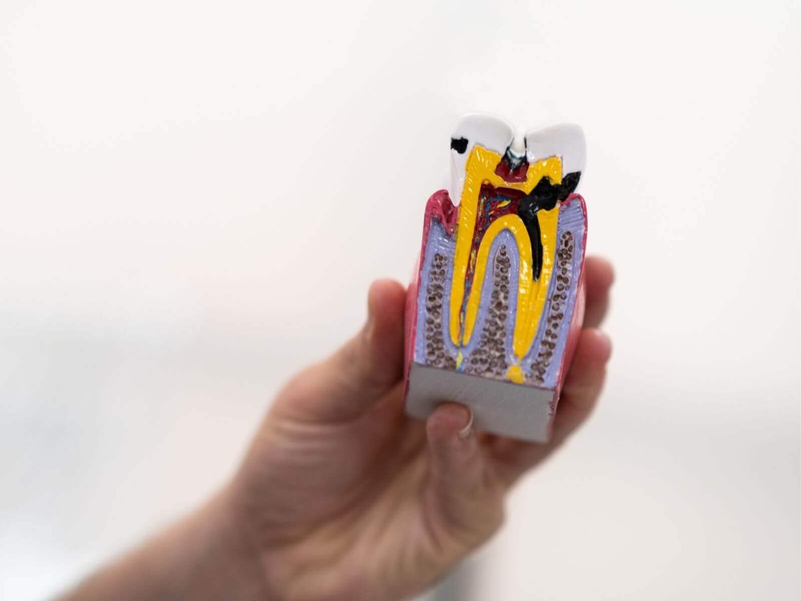 How Long Does a Root Canal Take? Front Teeth vs. Molars Explained