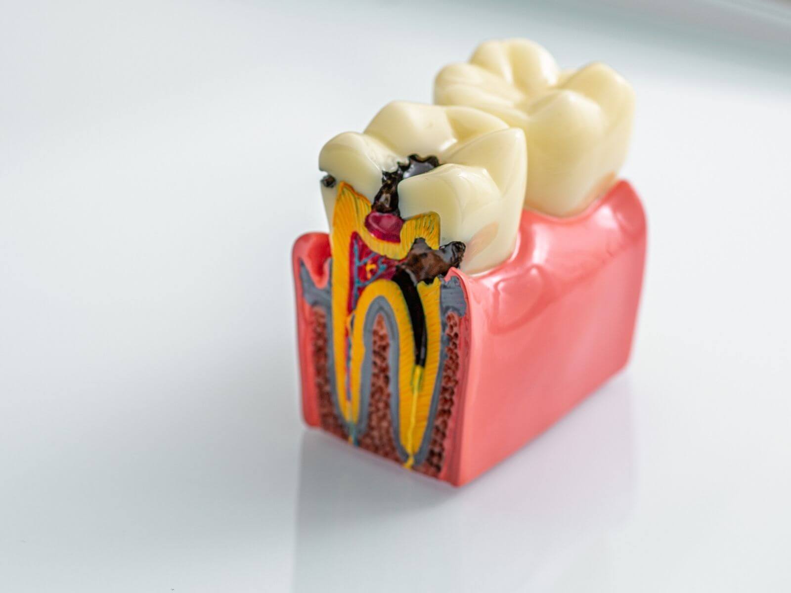 Tooth Cavity Filling: Types, Procedure, Cost, and Recovery Explained