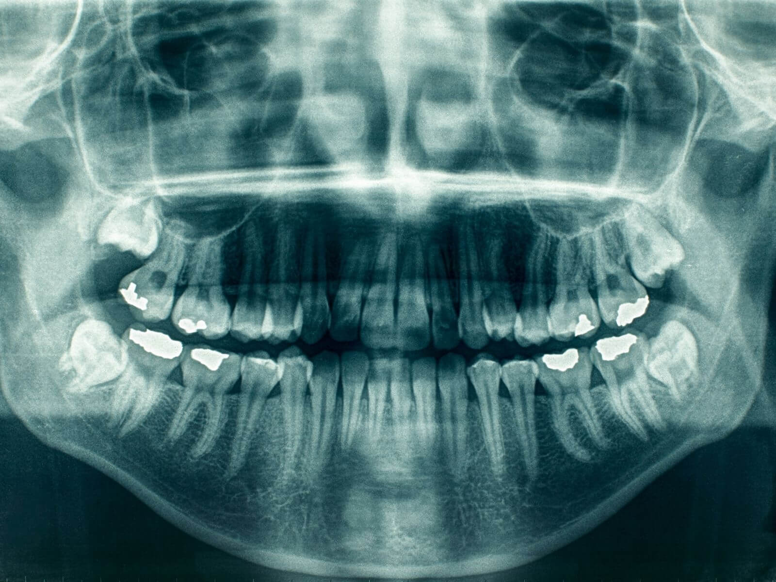 Why Are They Called Wisdom Teeth? The Surprising History