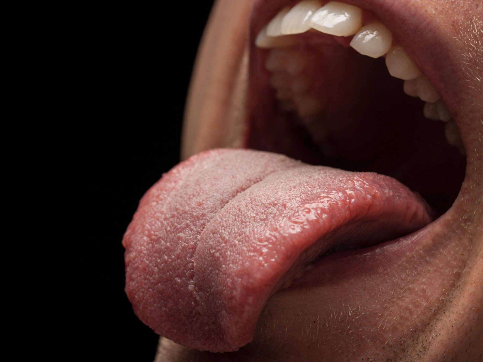 Tongue Tie in Adults: Symptoms, Oral Health Effects, and Treatment Options